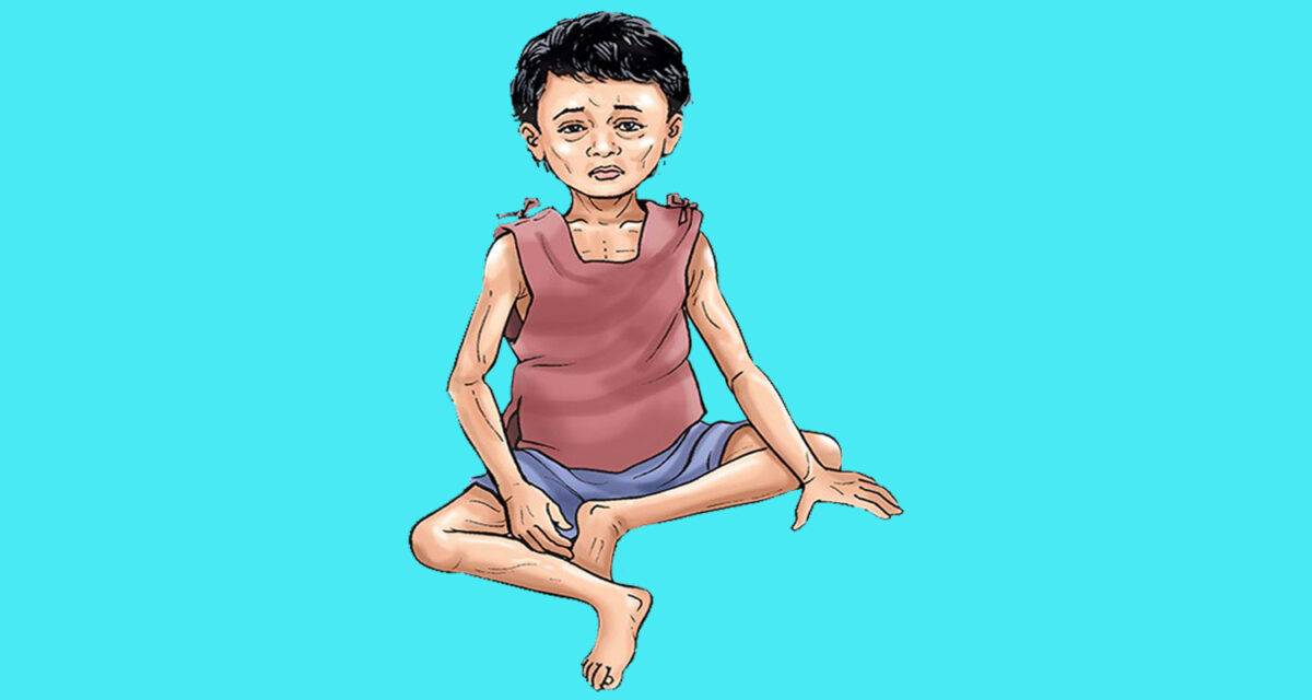 पोषण लेखाजोखाः टीकापुरमा तीन सय ४७ बालबालिका कुपोषित